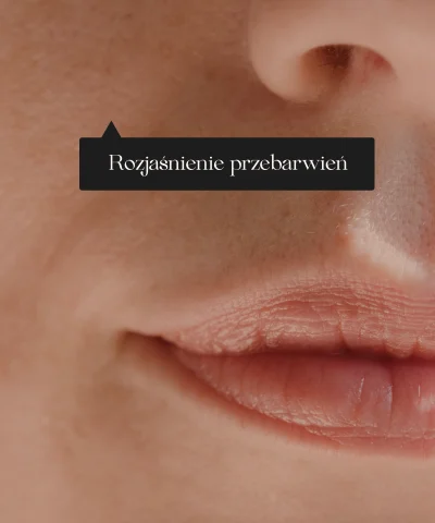 rozjaśnienie przebarwień