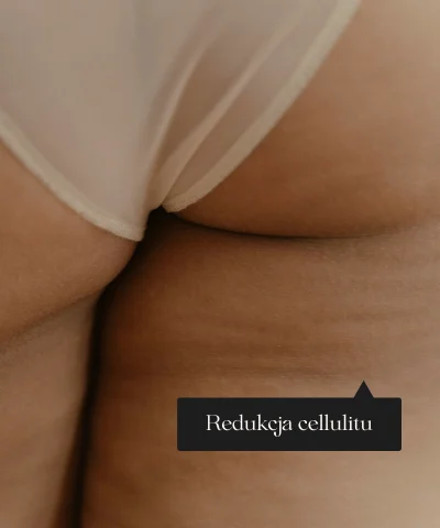 redukcja cellulitu